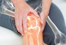 هشاشة العظام