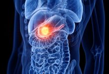 سرطان البنكرياس