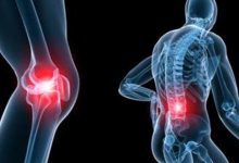  التهاب المفاصل.